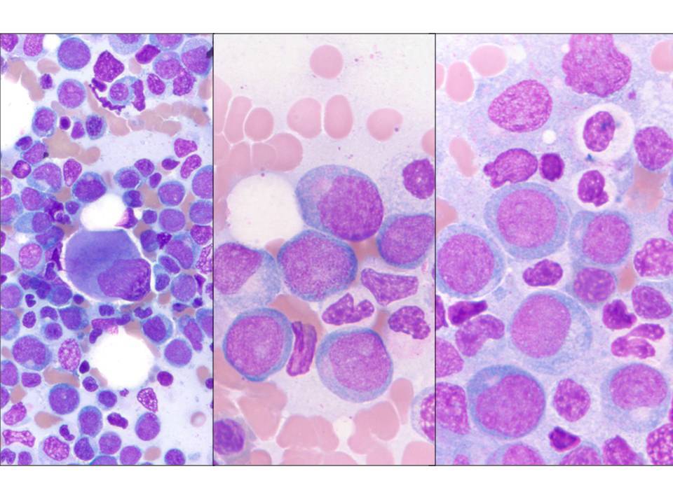 Bone marrow aspirate #2: In addition to the blasts, there are dysplastic, hypogranular neutrophils and dysplastic megakaryocytes.